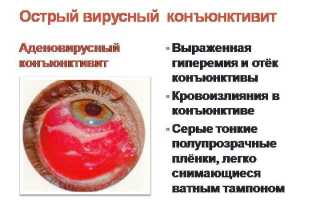 Вирусный конъюнктивит – ключевые симптомы и лечение глазных заболеваний