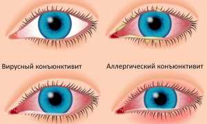 Как передается конъюнктивит в различных его формах? Узнайте подробности