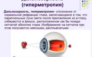 Гиперметропия высокой степени: определение, симптоматика и лечение глазных заболеваний