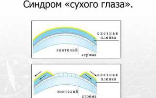 МКБ-10 – синдром сухого глаза: лечение, капли и рекомендации