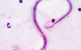 Что делать если в крови обнаружены гельминты