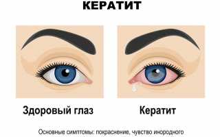 Кератит: виды, симптомы и способы лечения, народная и традиционная медицина