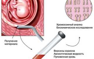 Кордоцентез при беременности: когда назначается, противопоказания и особенности процедуры