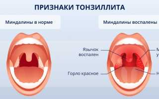 Лечение ангины во время беременности: методы терапии, медикаменты, народные средства и рекомендации специалистов