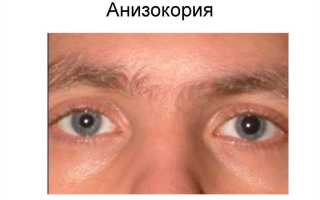Анизокория: причины возникновения симптома и его устранение у пациентов