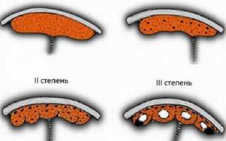 Преждевременное старение плаценты: что за патология, и чем она опасна для здоровья