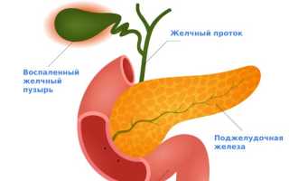 Холецистит хронический и острый: симптомы, лечение и диета, видео
