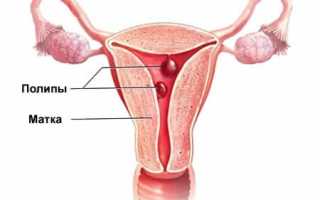 Децидуальный полип в шейке матки при беременности: причины и последствия
