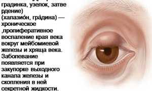 Лечение халязиона у детей – причины, как и чем лечить без операции, советы специалистов