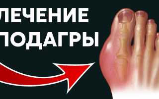 Подагра: лечение и профилактика, эффективные народные средства, полезное видео