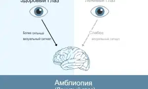 Амблиопия у детей: признаки, профилактика и лечение глазных заболеваний
