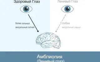 Амблиопия у детей: признаки, профилактика и лечение глазных заболеваний