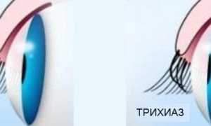 Трихиаз: симптомы, причины появления, лечение и профилактика