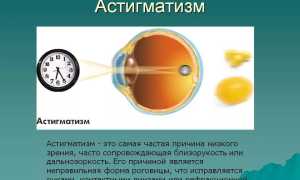 Сложный миопический астигматизм: основные признаки и лечение для пациентов