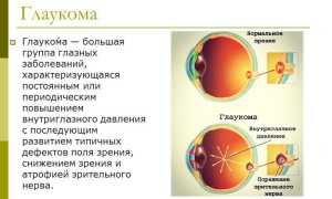 Как лечить глаукому и можно ли излечиться полностью? Полезные советы