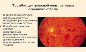 Тромбоз центральных вен сетчатки: описание и лечение проблемы для пациентов
