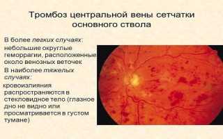 Тромбоз центральных вен сетчатки: описание и лечение проблемы для пациентов
