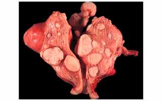 Некроз миоматозного узла, опасно ли это для здоровья?