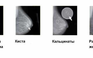 Маммография при беременности — можно ли ее делать и как это влияет на здоровье