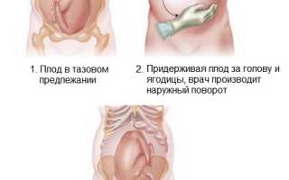 Наружный акушерский поворот плода при тазовом предлежании: методики и рекомендации