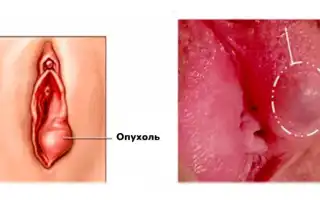 Была молочница зуд опухли половые губы