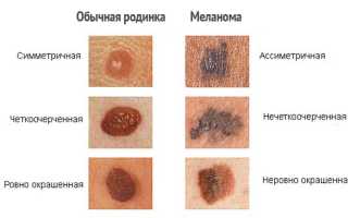 Меланома при беременности: как лечится и чем опасна для здоровья