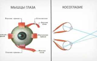 Косоглазие у детей – причины: до какого возраста у новорожденного косят глазки и что с этим делать