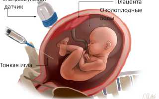 Амниоцентез при беременности, что это и как проводится