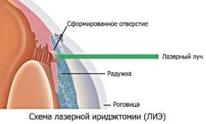 Лазерная базальная иридэктомия как эффективный метод лечения глаукомы: преимущества и результаты