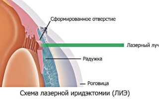 Лазерная базальная иридэктомия как эффективный метод лечения глаукомы: преимущества и результаты