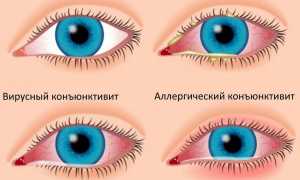 Мазь при конъюнктивите для глаз и капли – глазные для детей и взрослых