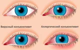 Мазь при конъюнктивите для глаз и капли – глазные для детей и взрослых