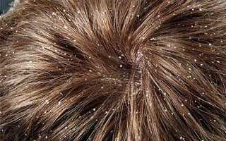 Как безопасно вылечить перхоть при беременности и сохранить здоровье