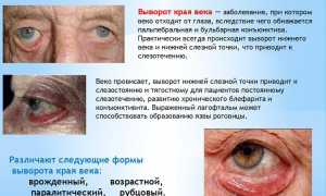 Выворот века: возможные причины, профилактика и лечение глазных заболеваний