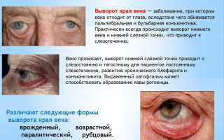 Выворот века: возможные причины, профилактика и лечение глазных заболеваний