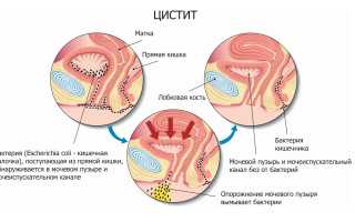 Как лечить цистит у женщин — простые и эффективные способы