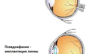 Афакия глаза: что это и как лечить? Полезная информация