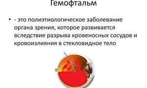 Гемофтальм глаза: что такое и как лечить? Полезные советы и рекомендации