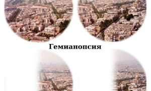 Гемианопсия: природа возникновения и методы устранения заболеваний зрения