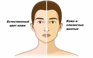 Желтуха при беременности: причины и последствия