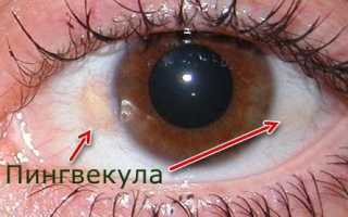 Пингвекула глаза: причины, методы лечения и профилактика заболевания