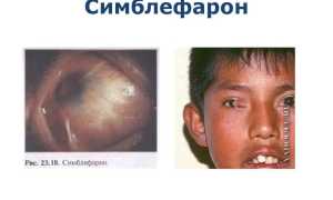 Особенности лечения и профилактики симблефарона у пациентов