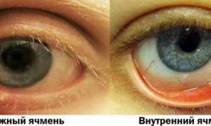 Из-за чего появляется ячмень на глазу – причины: как и почему вылазит, советы по профилактике