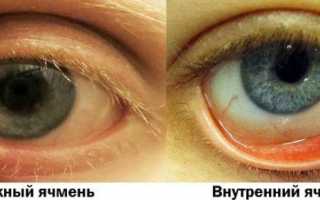 Из-за чего появляется ячмень на глазу – причины: как и почему вылазит, советы по профилактике