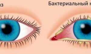 Лечение бактериального конъюнктивита и вирусного – капли глазные от стафилококка для здоровья глаз