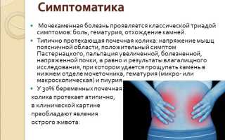 Лечение мочекаменной болезни при беременности: советы и рекомендации