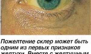 Желтый белок глаз у человека – от чего желтеет глазное яблоко и как это лечить