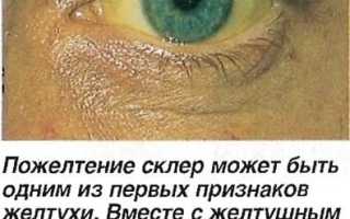 Желтый белок глаз у человека – от чего желтеет глазное яблоко и как это лечить