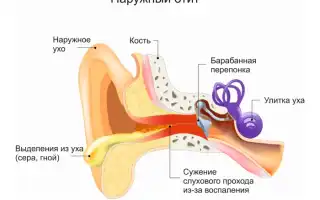 Лечение отита в домашних условиях: самые популярные и доступные средства