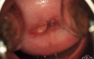 Кисточки на шейке матки: лечение народными средствами, мед. терапия, видео